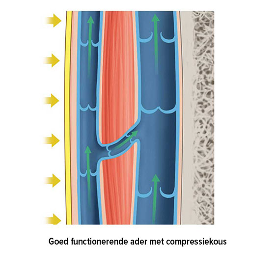 Goed functionerende ader met compressiekous