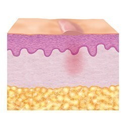 3. Repair phase (epithelisation)