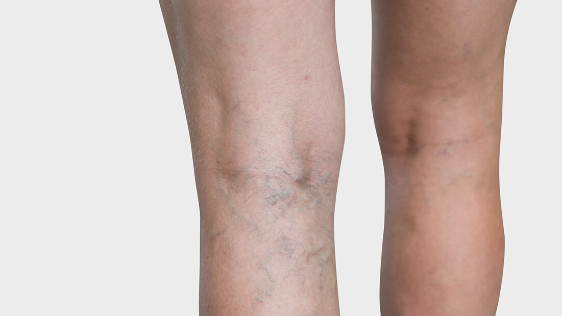 Beininnenseite, an der man Besenreiser sieht Beininnenseite, an der man Besenreiser sieht