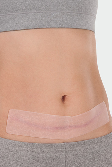 Juzo ScarPad, application on the abdomen Juzo ScarPad, application on the abdomen