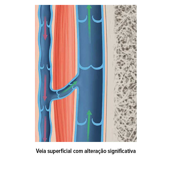Veia superficial com alteração significativa Veia superficial com alteração significativa