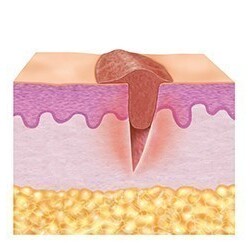 2. Granulation phase (proliferative phase)