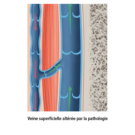 Veine superficielle altérée par la pathologie Veine superficielle altérée par la pathologie