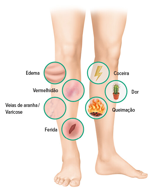 Úlcera venosa – Sintomas