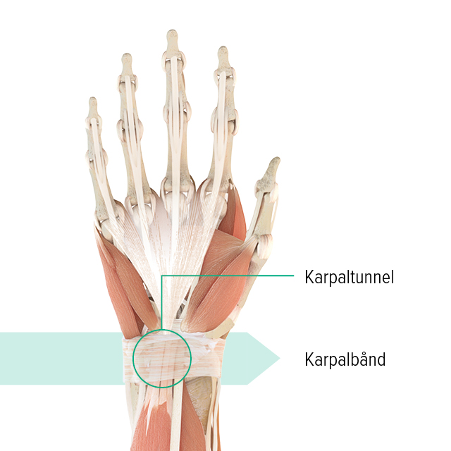 Anatomisk illustration af venstre hånd med markering af karpaltunnelen og karpalleddet
