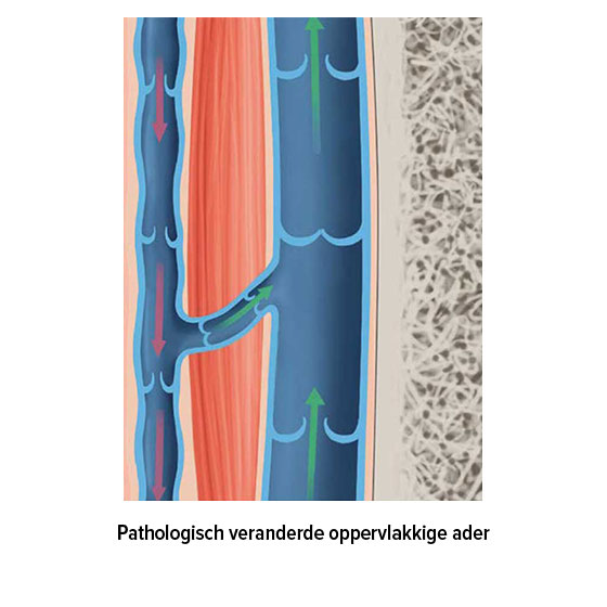 Pathologisch veranderde oppervlakkige ader