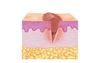 2. Phase de granulation (phase de prolifération) 2. Phase de granulation (phase de prolifération)