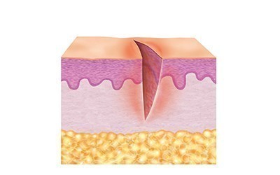 1. Phase de nettoyage (phase inflammatoire) 1. Phase de nettoyage (phase inflammatoire)