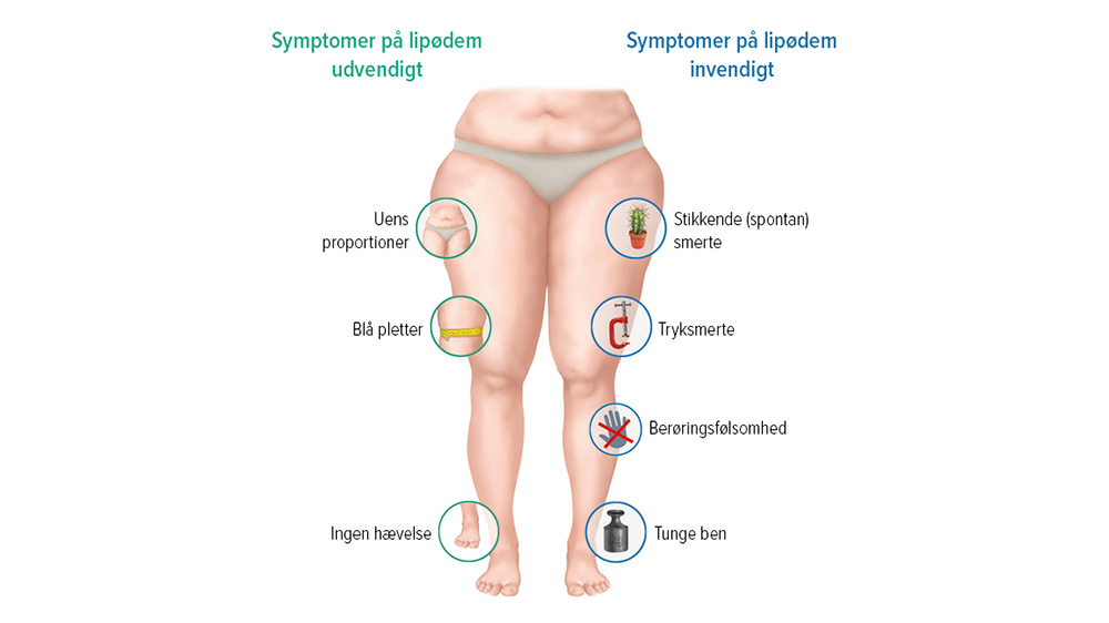 Grafik over symptomer ved lipødem Grafik over symptomer ved lipødem